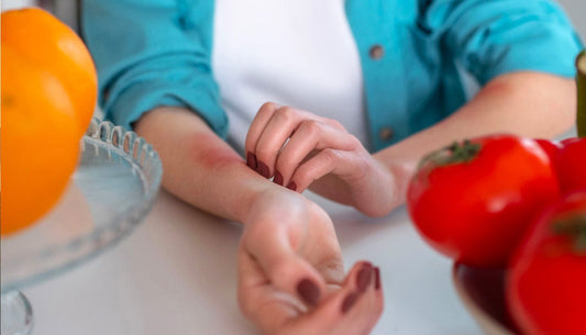 Food Allergies and Eczema: An Intricate Connection